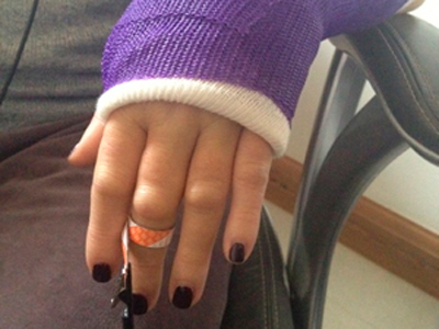Broken wrist (EX735Ag Slider x2)