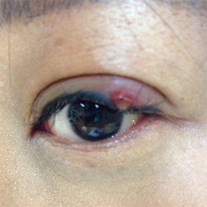 Using ENT01Ag remote electrode for treatment of eyelid inflammation